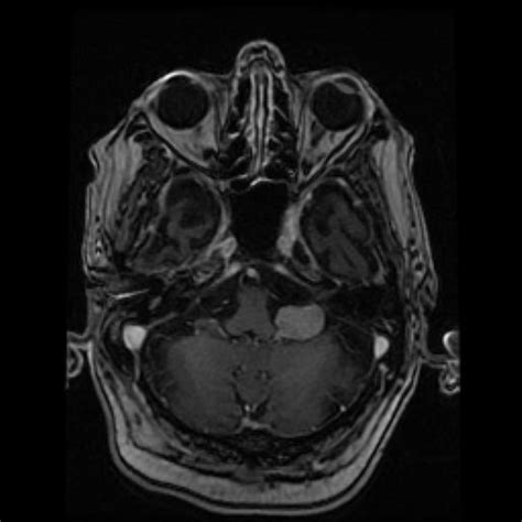 Glossopharyngeal Nerve Schwannoma Image Radiopaedia Org