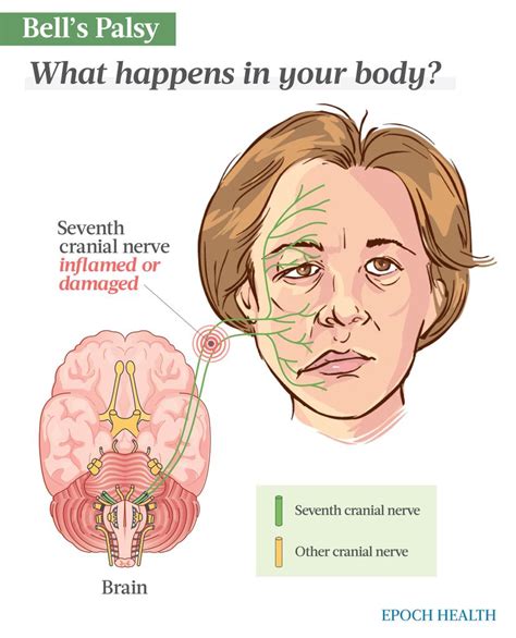 The Essential Guide To Bells Palsy Symptoms Causes Treatments And