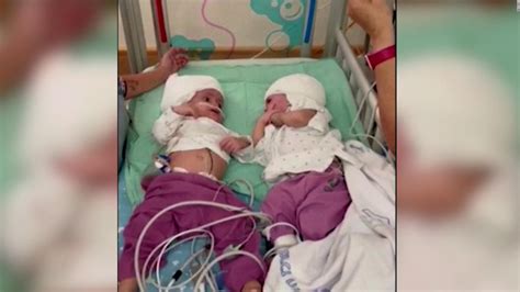 The Moment When Separated Twins Meet For The First Time After Surgery Video Cnn The