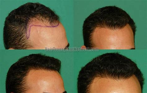 Dr Raymond Konior Female Hair Transplant Procedure Before And After Result Images With 1880 Grafts