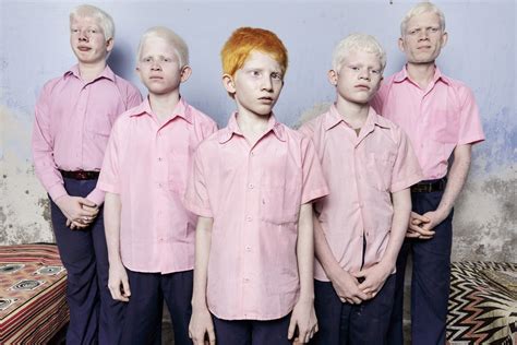 Indian Boys with Albinism — Brent Stirton