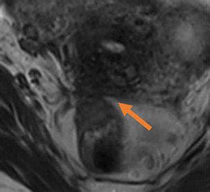 MRI of Endometriosis - RAD-ASSIST