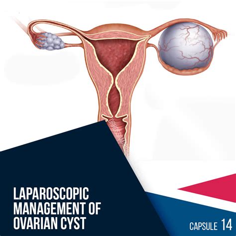 Capsule 14 Laparoscopic Management Of Ovarian Cyst Excluding