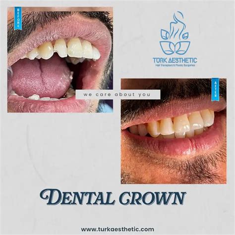 Dental Crown And Dental Bridge 2024