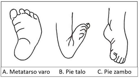 Deformaciones Frecuentes En Los Pies Tipos Y Causas Neurat