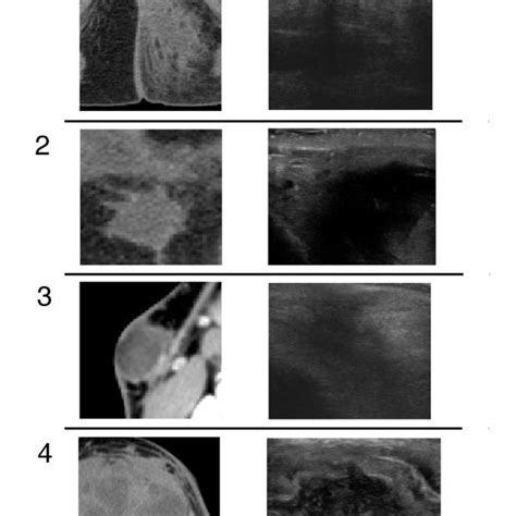 Us And Ct Of Patient With Buttock Abscess Figure A Demonstrates Ct