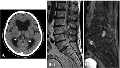 Preoperative Computed Tomography CT A Shows A Ventricular