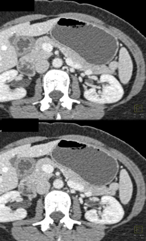 Gastrointestinal Learning Modules Ct Scanning