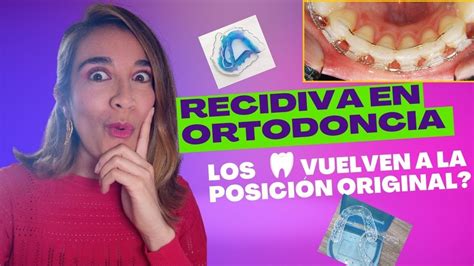 RECIDIVA EN ORTODONCIA La Importancia De Los RETENEDORES EN ORTODONCIA