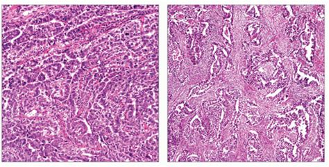 Embryonal Carcinoma | Basicmedical Key