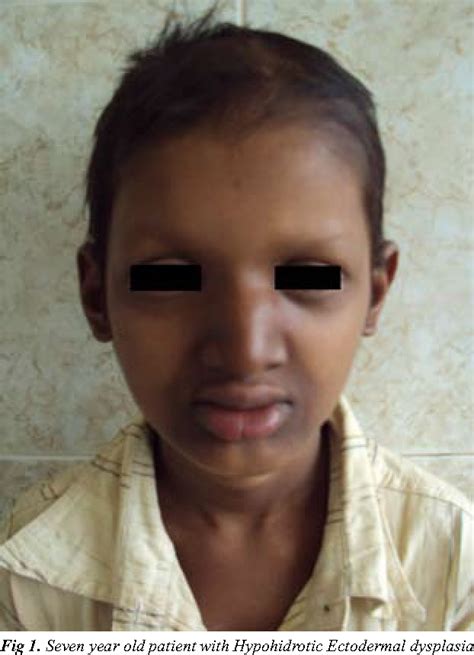 Children With Ectodermal Dysplasia