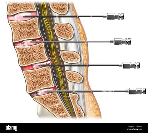 Disc Herniation Radiculopathy Hi Res Stock Photography And Images Alamy