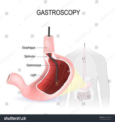 Gastroscopy Esophagoscopy Duodenoscopy Diagnostic Procedure Endoscope ...