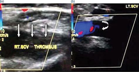 Atypical Presentation Of Lemierre Syndrome Role Of Imaging Bmj Case