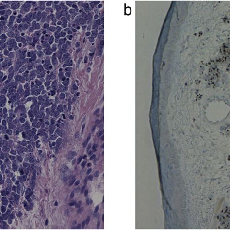 Typical Histopathologic Appearance Of Merkel Cell Carcinoma A Large