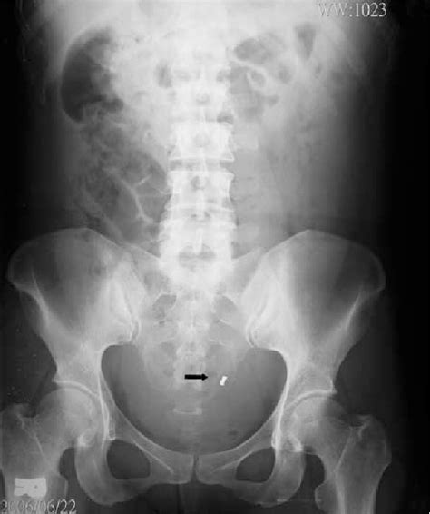 Figure 1 From Delayed Diagnosis Of Ectopic Pregnancy After Fallopian Tubal Ligation A Case