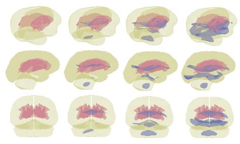 Vulnerable Brain Regions Duri [image] Eurekalert Science News Releases