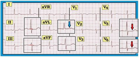 Ecg Interpretation Ecg Interpretation Review St Depression St