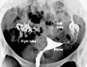 Hysterosalpingogram Hsg Test For Tubal Infertility