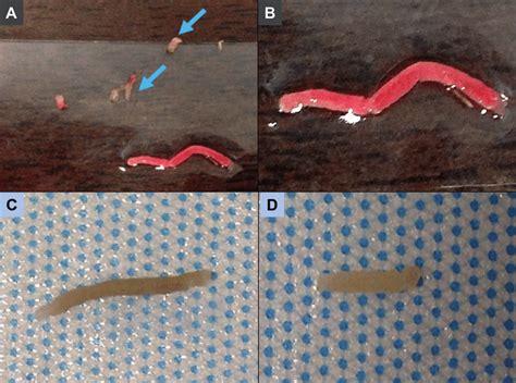 Images demonstrating appearance of kidney biopsy cores as shown to the... | Download Scientific ...