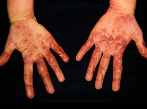 Figure Erythema Multiforme Dermnet New Zealand Statpearls Ncbi Bookshelf