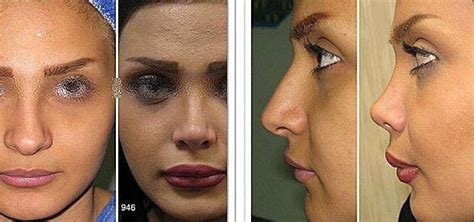 Iranian Rhinoplasty Photos 1 Rhinoplasty Cost Pics Reviews Qanda