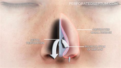 Perforated Septum, Dr. Hamilton - Surgical Repair of a Hole in the Septum