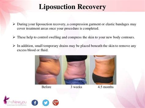 Liposuction