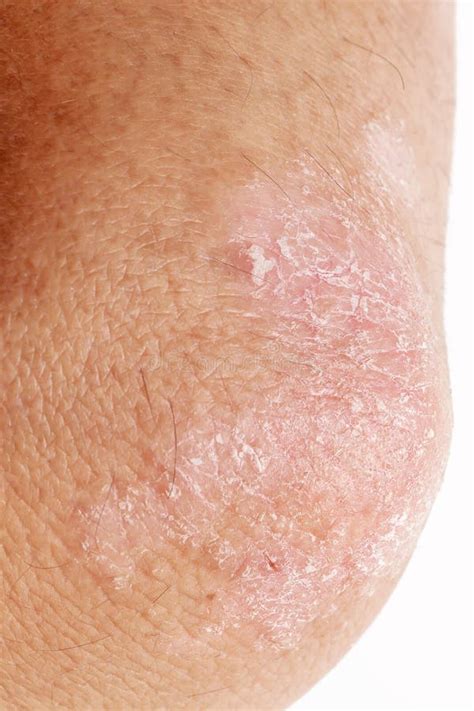 Psoriasis On Elbow Isolated Closeup Of Rash And Scaling On The Patient`s Skin The Concept Of