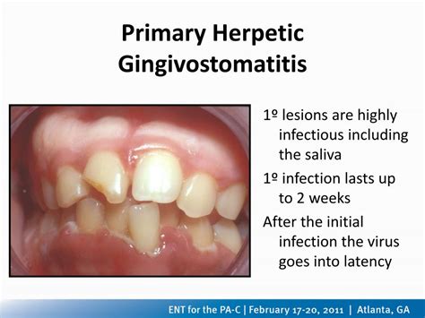 Ppt Differential Diagnoses And Treatment Of Oral Lesions Powerpoint