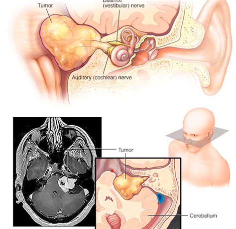 Neuroma Do Ac Stico Schwannoma Vestibular Tratamento Porto Alegre