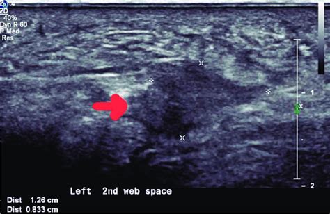 Red Arrow Shows A Hypoechoic Mass Seen On Ultrasound Suggestive Of Download Scientific Diagram