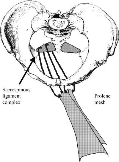 Repair Of Recurrent Vaginal Vault Prolapse Using Sacrospinous Ligament