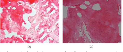 Cementoblastoma Histology