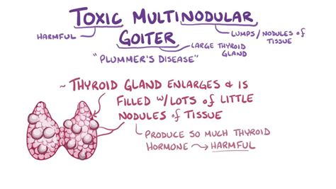 Toxic multinodular goiter: Video, Anatomy & Definition | Osmosis