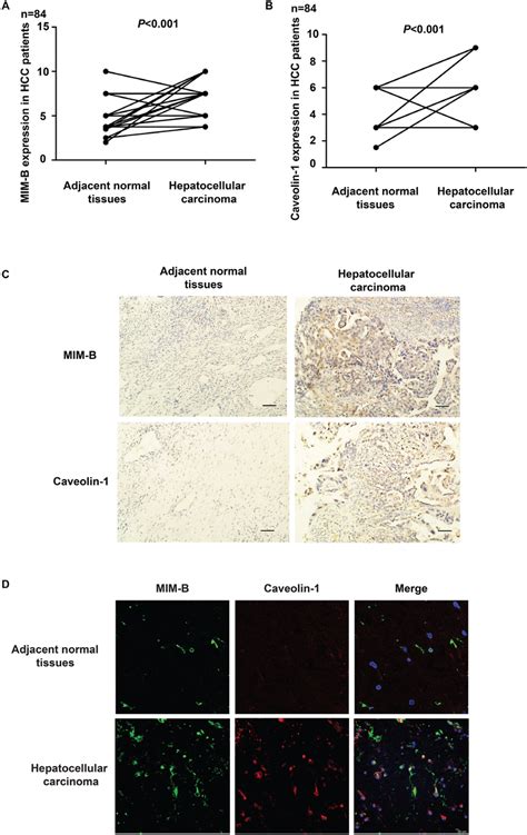 Mim B And Caveolin 1 Are Aberrantly Expressed In Hcc A Ihc Showing