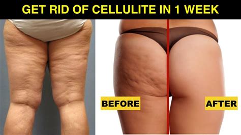 How To Get Rid Of Cellulite On Thighs And Bum Fast At Home Just 1