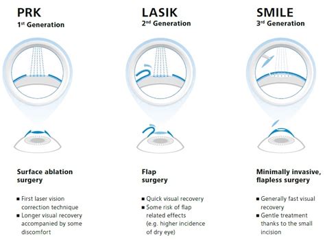 Latest update on SMILE laser eye surgery — Advanced Vision Surgery