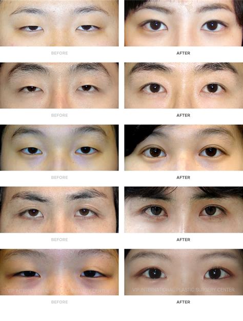 Korean Plastic Surgery Before And After Eyes