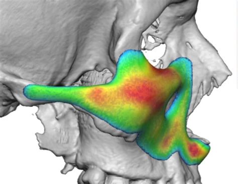 Plastic Surgery Case Study Achieving A Non Osteotomy Midface