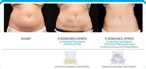 Le Coolsculpting La Cryolipolyse Par Zeltiq LAZEO PARIS Centre De