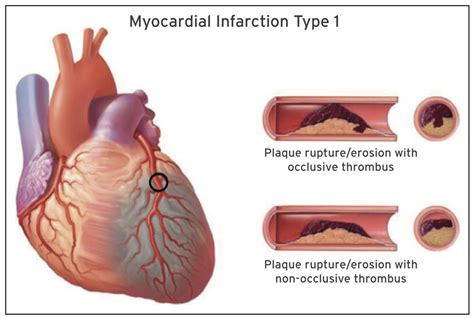 Infarctus du myocarde sans élévation du segment ST Wikimedica