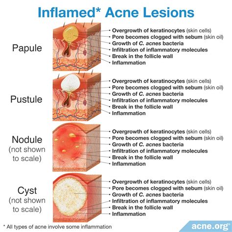 What Is the Difference Between Inflamed and Non-inflamed Acne?