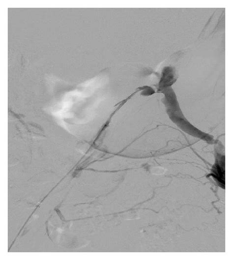 Aortoiliac And Femoral Angiogram Showing Complete Occlusion Red Arrow Download Scientific