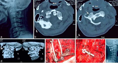 Figure 1 From Traumatic Chronic Irreducible Atlantoaxial Rotatory