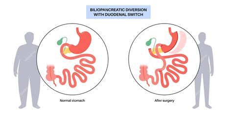 Premium Vector Biliopancreatic Diversion With Duodenal Switch Bpd