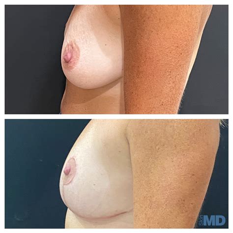 Breast Lift Surgery In Boston Skin Md Laser Cosmetic Group