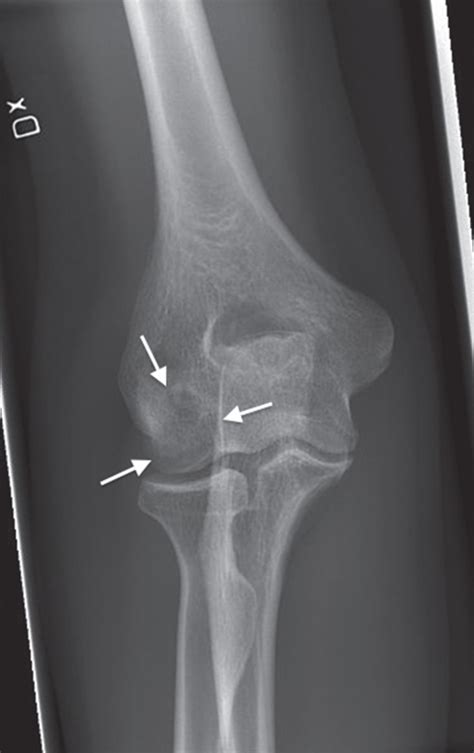 Standard Anteroposterior Radiography Of The Elbow Months