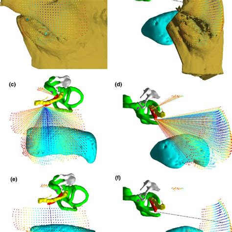 Measurement of stapes footplate thickness. (A) Normal control. Line in ...