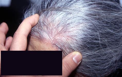 Superficial Fungal Infections Tinea Capitis In An Adult Picture